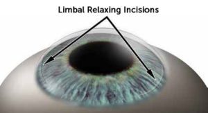 limbal1 300x163 An image of an eyeball showing wearing the limbal relaxing incisions will be made during surgery.