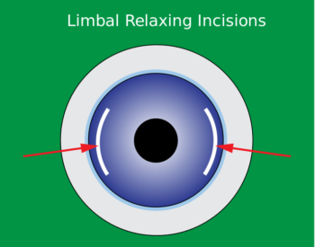 limbal relaxing incisions.svg a diagram showcasing wearing limbal relaxing incisions are placed